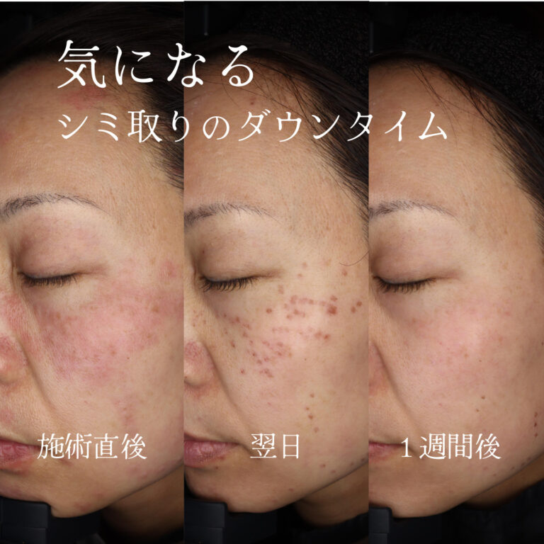 シミ取り後のダウンタイム | 【公式】Les芦屋スキンクリニック｜神戸市東灘区の美容皮膚科